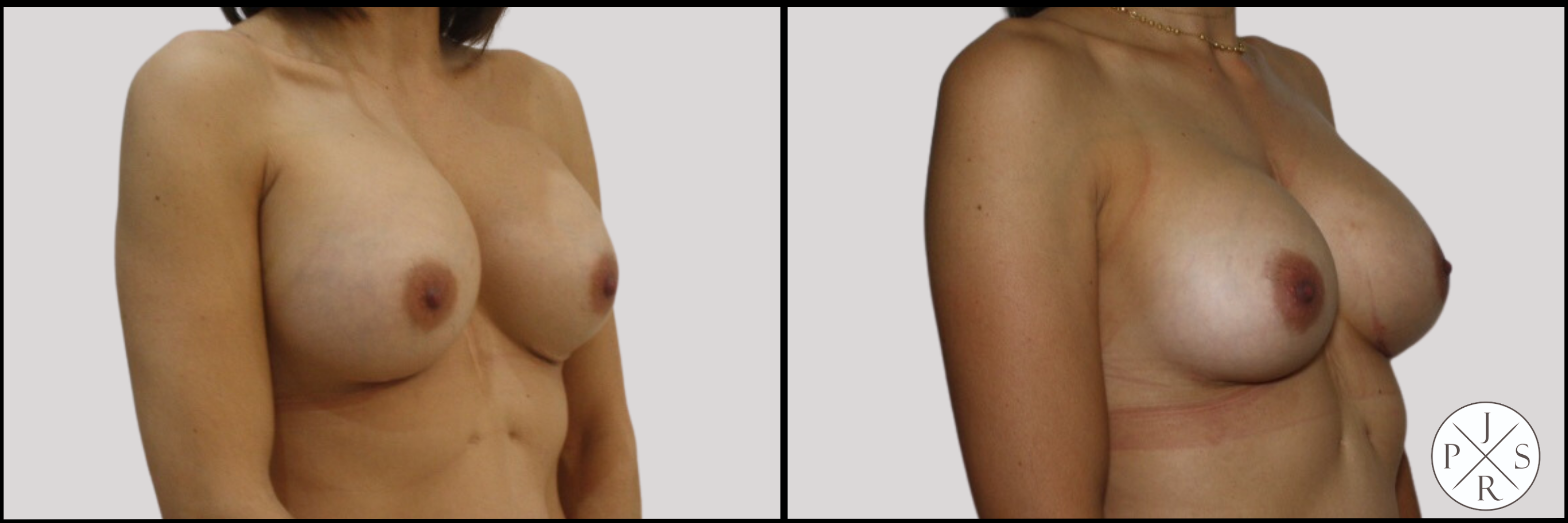 Breast Revision Before & After Image